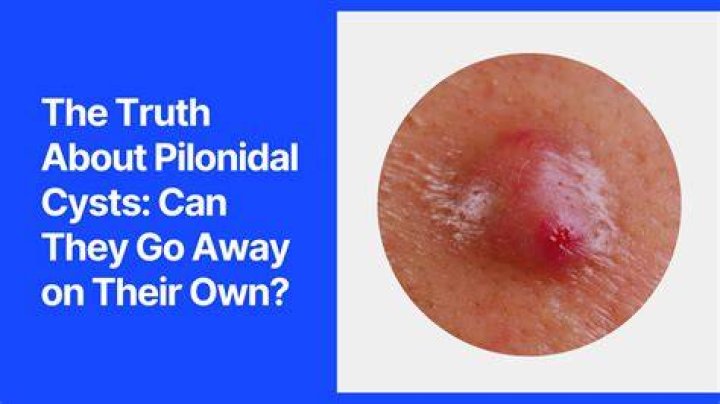 Can girls get pilonidal cyst