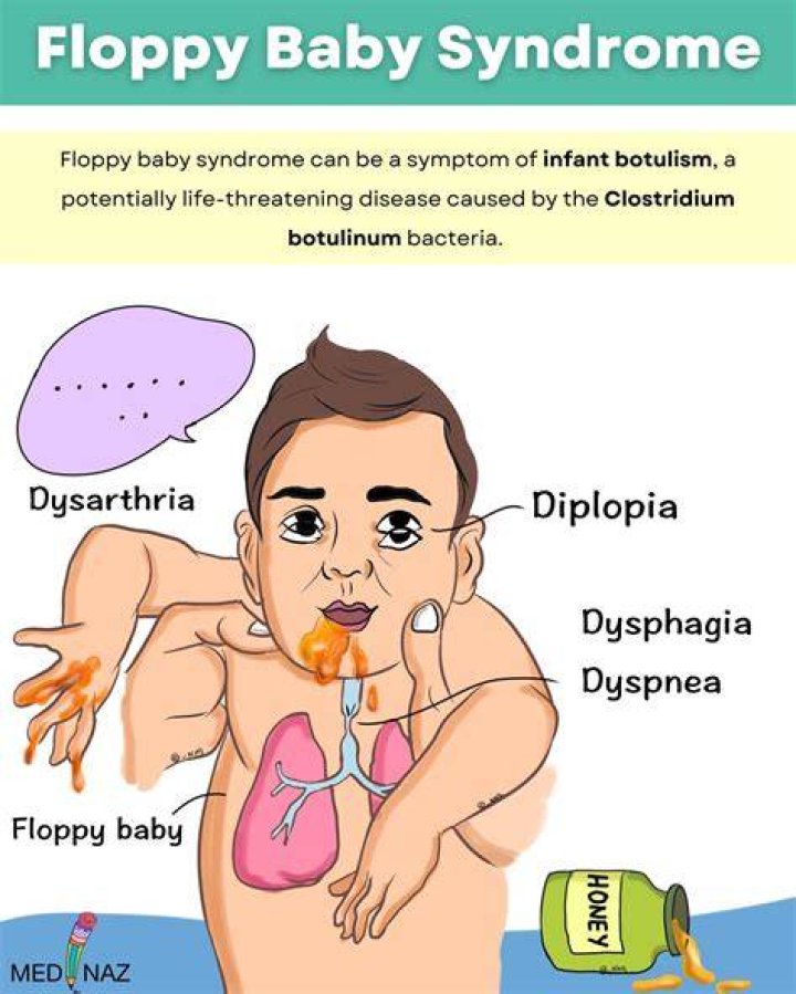 Is there a cure for floppy baby syndrome