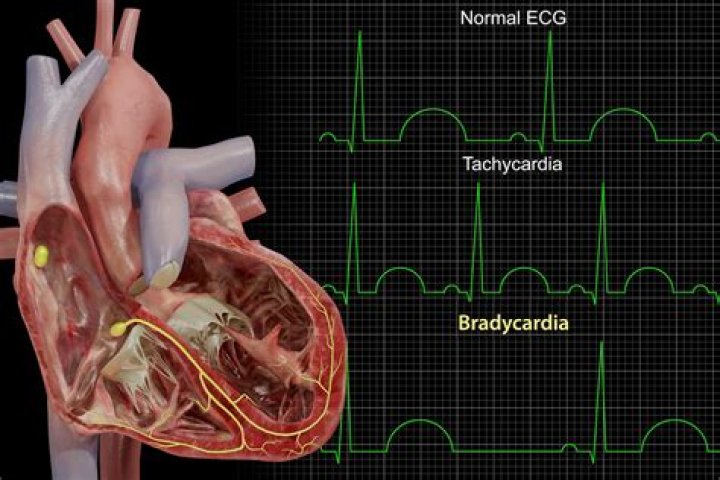 What causes fetal bradycardia during labor