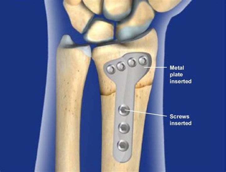 What is an ORIF surgery