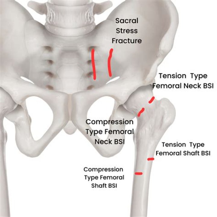 What is femoral neck stress fracture