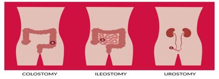 What is the most common type of ostomy