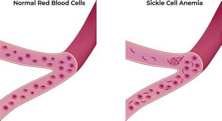 Whats the difference between anemia and sickle cell